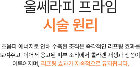 울쎄라피 프라임 시술 원리